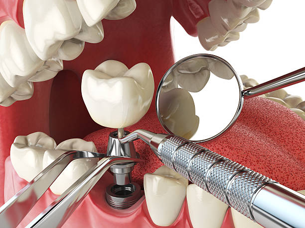 Best Emergency Dental Care for Broken or Chipped Teeth in Lebanon, PA